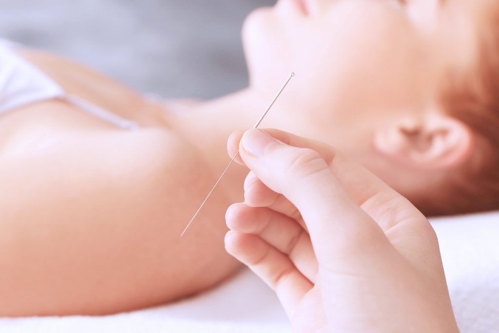 4 Ways Acupuncture Can Make You Feel Better