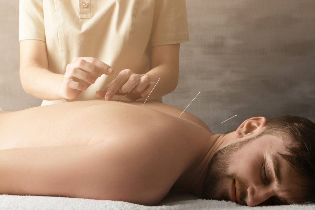 7 surprising facts about acupuncture