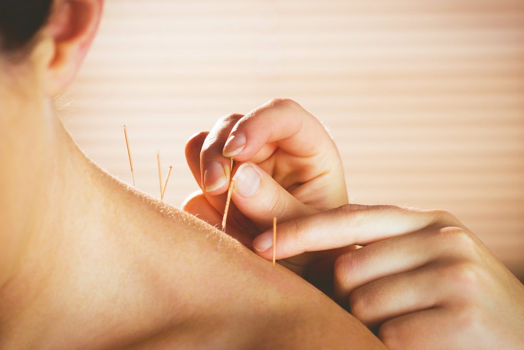 Ways Acupuncture Can Help With Chronic Pain